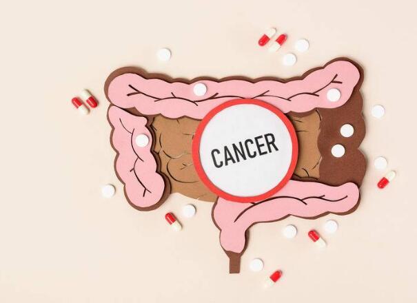 肠癌来袭时，大便早已发出3个明显信号，若发现，及时做肠道筛查