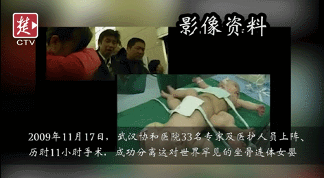 超级宝妈▲11年前，国内首例连体婴，如今她们长这样，网友：很有惊喜！