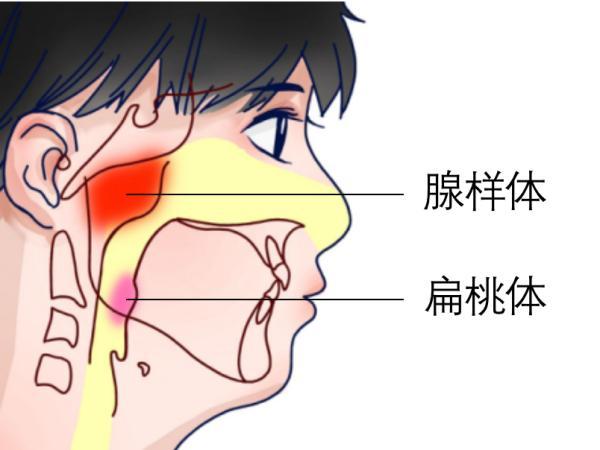 呼吸|世界睡眠日｜孩子鼾声背后的秘密