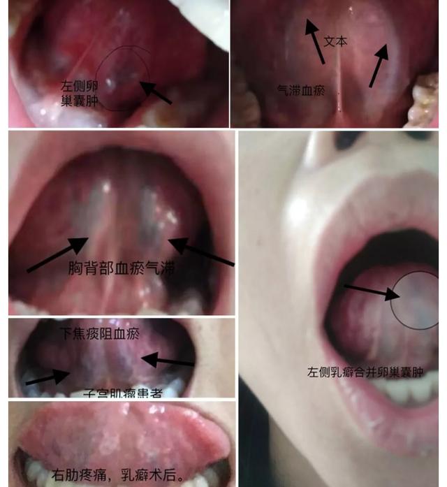 从舌相上能看出肌瘤和肌瘤生长部位吗？