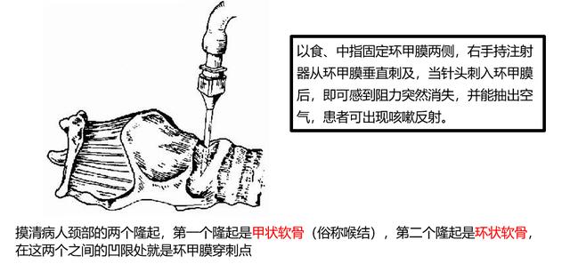 窒息|用环甲膜穿刺急救有哪些禁忌？医生手把手
