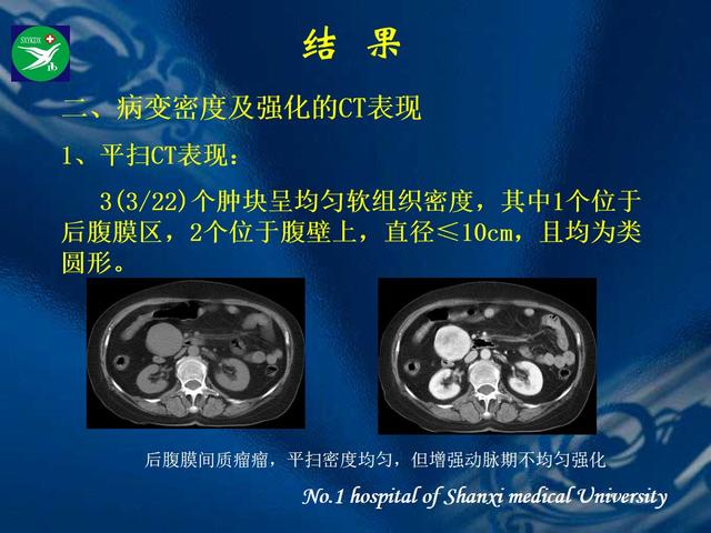 李健丁教授：胃肠道外间质瘤的CT表现和临床病理分析