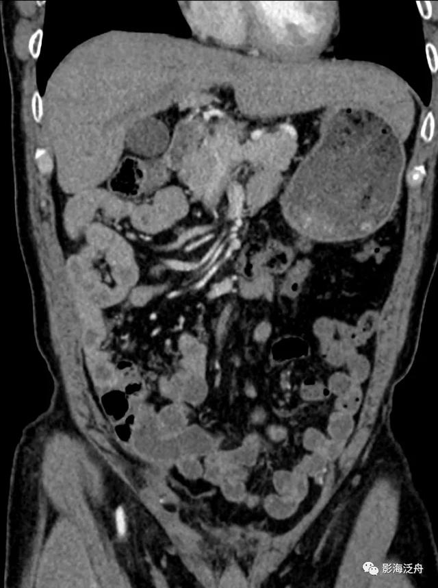 这个病，腹部CT经常会漏诊