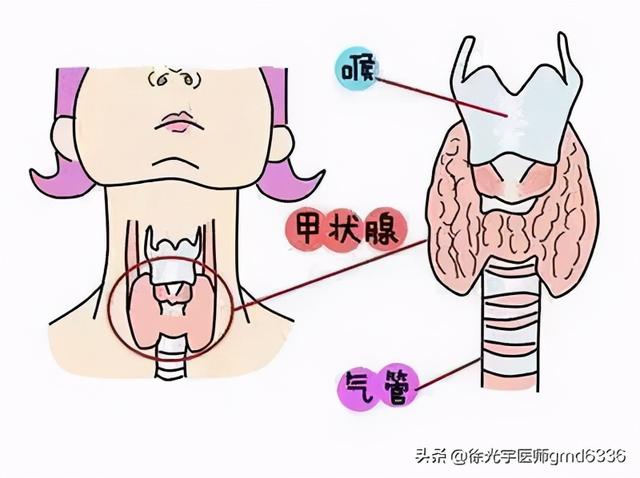 4个月结节消失，8个月炎症状全无，甲状腺结节不可怕