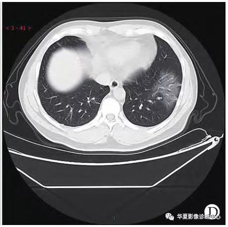 「影像进展」新冠肺炎的CT典型和不典型表现以及影像学分期