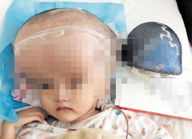 超级宝妈▲再现“大头娃娃”！湖南“假奶粉”坑骗家长，幼儿颅骨突出起湿疹
