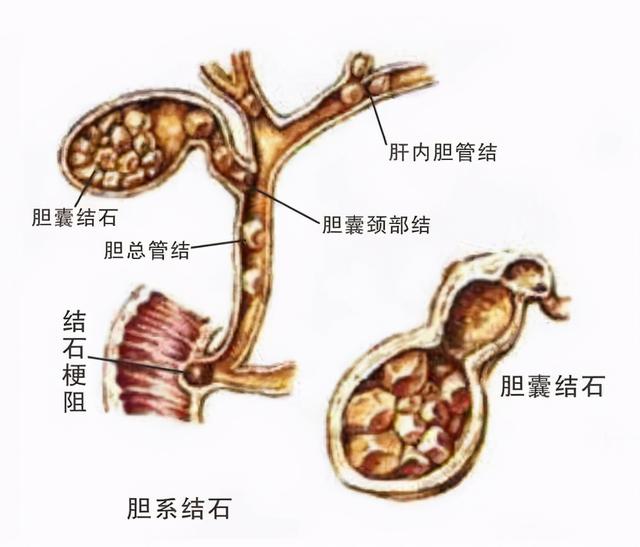 胆结石为何冬季高发？关于胆结石，你想知道的都在这里