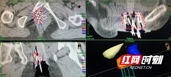 放疗|放射源直接放到肿瘤里 湖南省肿瘤医院运用3D打印技术精准放疗