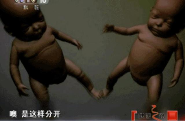 超级宝妈▲11年前，国内首例连体婴，如今她们长这样，网友：很有惊喜！