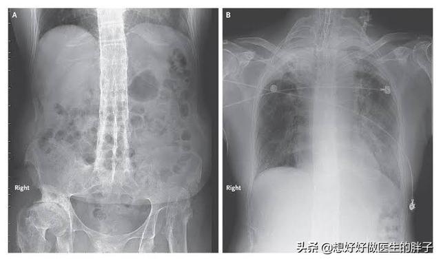 年轻男性、下背部疼痛，晨起加重活动缓解，要小心这个缠人的疾病