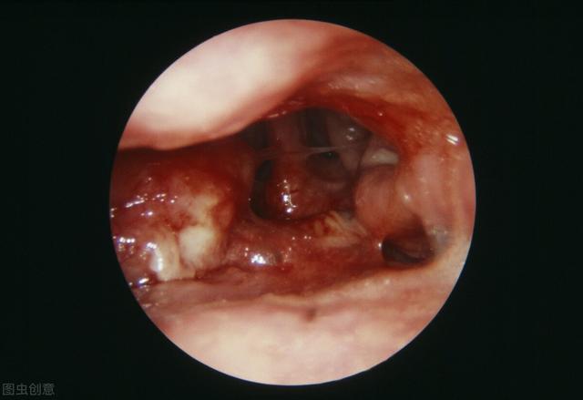 提前发现鼻咽癌，你可能需要知道这些