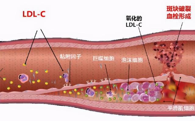 血脂高会引起哪些具体危害，高血脂人群应如何控制饮食