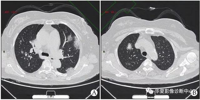 「影像进展」新冠肺炎的CT典型和不典型表现以及影像学分期