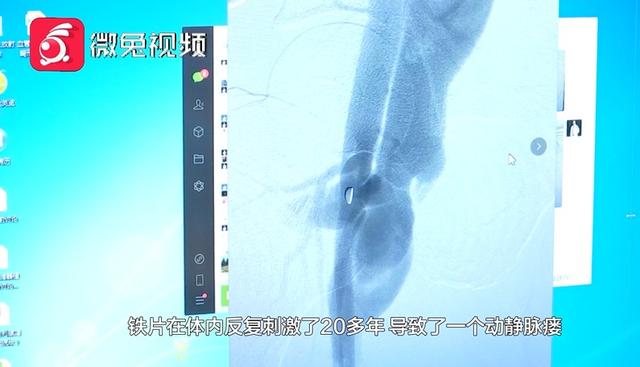 师傅|惊！贵阳一男子腿部剧痛、皮肤发黑！竟是铁片藏里面20多年