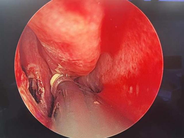 鼻息肉|“感冒”两年后，9岁小男孩的鼻子里长出“荔枝”，需要手术切除