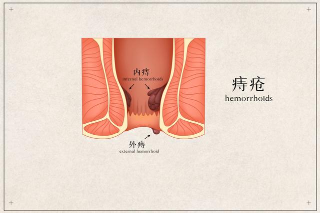 得了痔疮后等它自愈还是用药物治疗呢？注意这几点，治疗效果更好