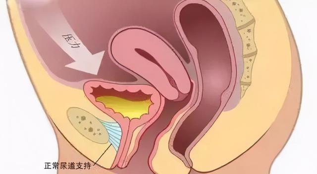 产后尴尬：咳嗽跳绳就漏尿？一个动作可以帮你改善