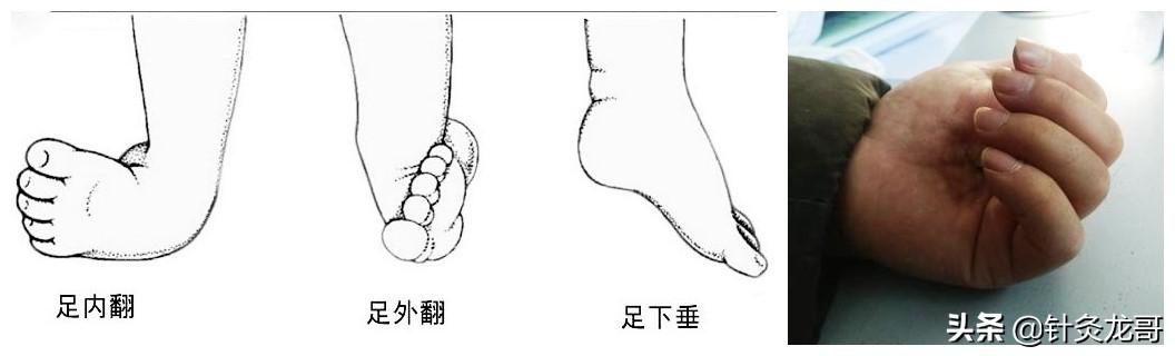 中风后遗常见症状的针灸取穴介绍