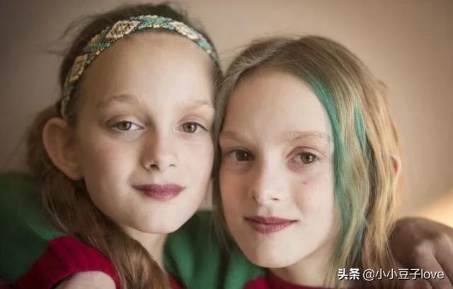 盈袖兰香|如果连体婴有一个离世了,剩下的一个会怎样?看完鼻头一酸!