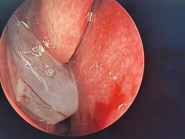 鼻息肉|“感冒”两年后，9岁小男孩的鼻子里长出“荔枝”，需要手术切除