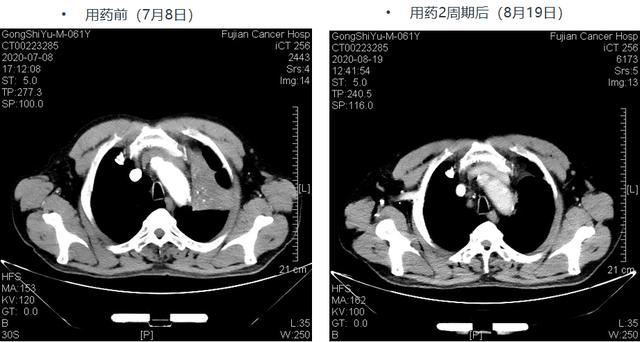 百例之约 | 新辅助免疫联合化疗为中晚期肺鳞癌患者带来惊喜！患者术后实现pCR