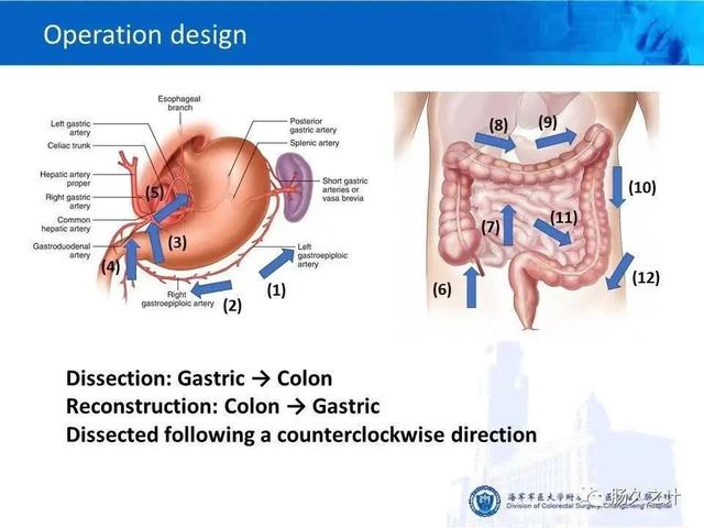 手术|长征医院肛肠外科周海洋教授在英国肛肠协会会刊发表系列手术视频
