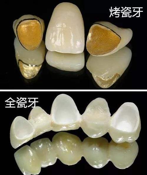 全瓷牙到底比烤瓷牙好在哪？为何医生都首推全瓷？听听牙医的详解