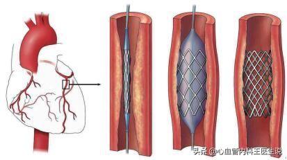 心脏支架降到700元，对患者和医生有什么影响？