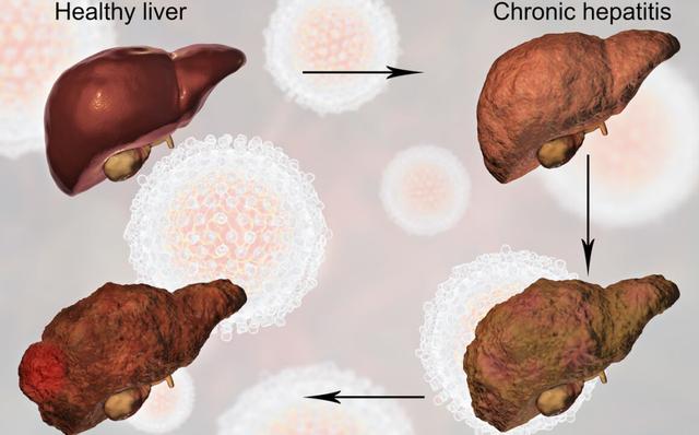 28岁男子肝癌离世，医生叹息：都是木耳惹的祸，劝你尽量别碰