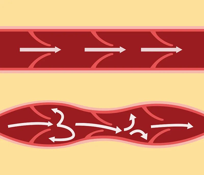 外科|静脉曲张会导致截肢？！这种常见病，千万别轻视→