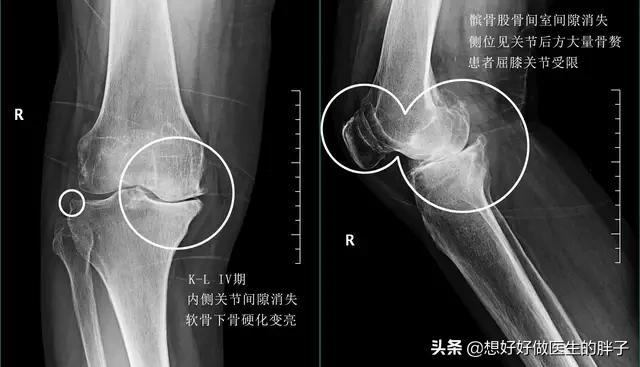 滑膜炎|当父母老了，出现膝盖疼痛令您着急苦恼，用烤灯能解决问题吗？