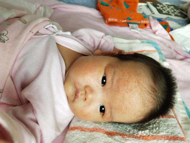 [超级宝妈]婴儿湿疹之谈