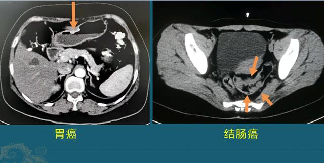 生存期较长的癌症有哪些？