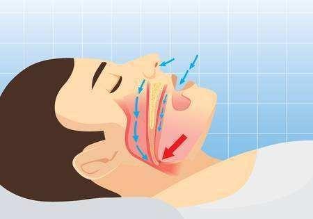一夜呼吸暂停387次，睡觉打呼噜差点"送"走自己，打鼾也是病