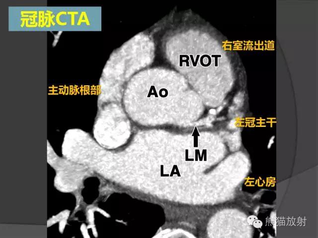 冠状动脉系统解剖、CTA解剖、分段及中英文名称对照