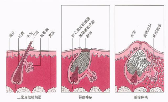 痤疮怎么区分严重程度