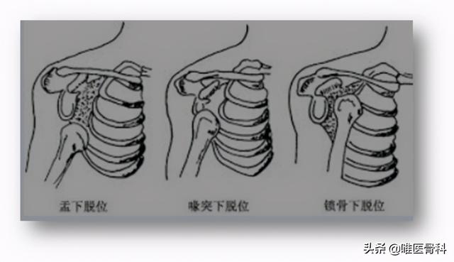 肩膀疼？一个动作，自测是否有肩关节脱位