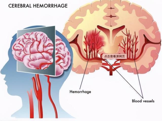 脑出血已经“盯上”年轻人！出现这几个发病先兆，赶紧去医院！