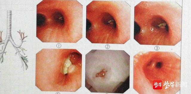 女士|咳嗽老不见好，感冒药、咳嗽药都没用，CT一查，气管里藏着一个鸡骨头