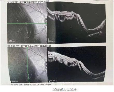 母亲|17岁女孩视网膜脱落错过72小时黄金治疗期 母亲痛悔自责……
