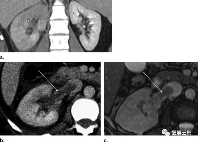 24张图汇总「肾血管」常见病变的影像学表现