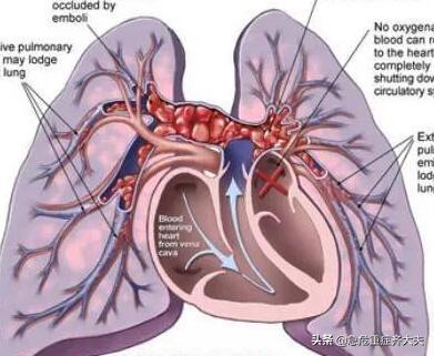 右心室|久坐也会致命？不知此病要出大问题