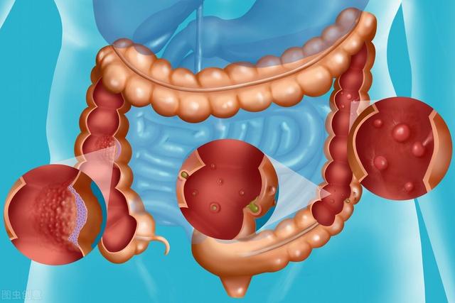 患有“肠息肉”的人，晨起上厕所会有这三个异常特征？要知道