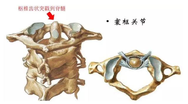 一到冬天总落枕？这两种像极了落枕的病，处理不好会引发瘫痪