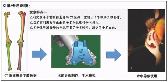 3D打印手术导板在膝关节内外翻畸形患者全膝关节置换中的应用