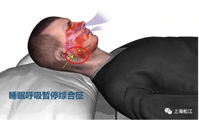 打鼾|你睡觉打呼噜吗？这种情况很危险