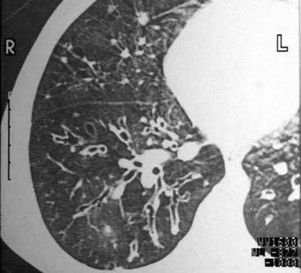 支气管扩张体征、症状与诊断，这一篇文章就够了！│临床必备