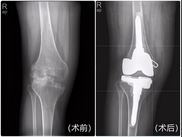 “重男轻女”的血友病可致残，幸亏遇到他们