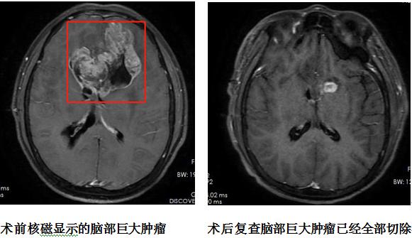 男子突然沉默寡言，医生：再晚来一点，可能撑不过这个月！原来是脑袋里长了这东西