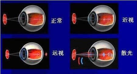 有趣生活|家长注意：这种视力问题，很容易忽视